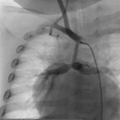 Case Report: “Smart Palliation” and “Clepsydra Shape”: A new approach in complex congenital heart disease